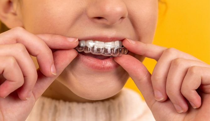 7 claves de publicidad para tu clínica dental Un primer plano muestra a una persona colocando un alineador de ortodoncia transparente sobre sus dientes superiores sobre un fondo amarillo vivo, resaltando la precisión y el cuidado típicos de una clínica dental de renombre.